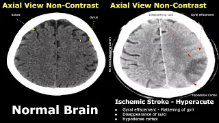 CT Scan Brain Normal Vs Ischemic Stroke Images | Non-Contrast Hyperacute/Acute/Chronic Infarction