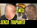 Lagu HA RECUPERATO I CAPELLI IN 3 MESI - la storia di Simone