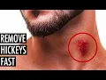 Best Ways to Get Rid of or Hide a Hickey Remove a Hickey Fast Tiege Hanley