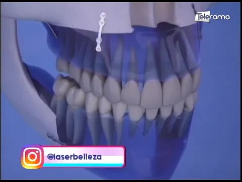 Prognatismo: Cirugía para mandíbulas grandes