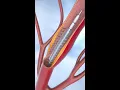 Download Lagu Coronary Angioplasty and Stent Insertion #animation #shorts #anatomy #science #asmr