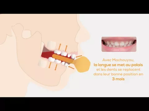 Comment Machouyou réaligne les dents : dessin animé