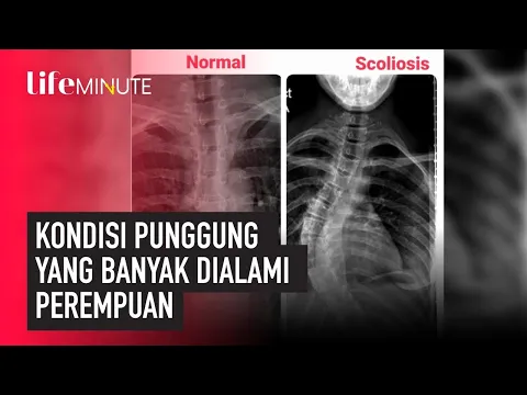 Inilah Kondisi Penyakit Punggung yang Sangat Sering Dialami Perempuan | lifestyleOne
