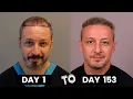 HAIR TRANSPLANT TIMELAPSE DAY 1 TO DAY 153 GROWTH IN 5 MONTHS BEFORE AFTER