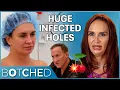 Tanna Had HUGE Infected Holes In Her Boobs After Removing Her Implants Botched E