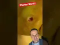 Lagu AMAZING PLANTAR WART REMOVAL! 😱#shorts