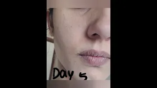 Tretinoin Cream 0 05 