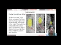 CENTRAL POCKET LOOP WHORL