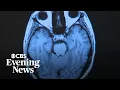 Researcher says Long COVID causing great deal of suffering