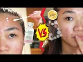 Acne Drying Lotion VS Acne Patches