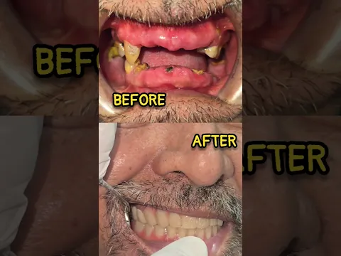 Smile with full mouth rehabilitation at Mumbai Dental ,Ulwe,Navi Mumbai