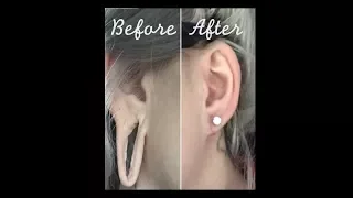 My Earlobe Reconstruction Vlog