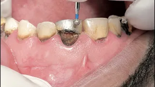 Saving a Severely Decayed Upper Central Incisor with Root Canal & Composite Build-Up 🦷🦷🦷