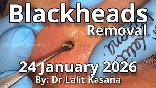 Deep Blackhead Removal by Dr.Lalit Kasana (24 January 2026)