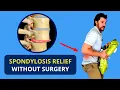 Spondylosis Treatment Without Surgery Spondylolisthesis Causes