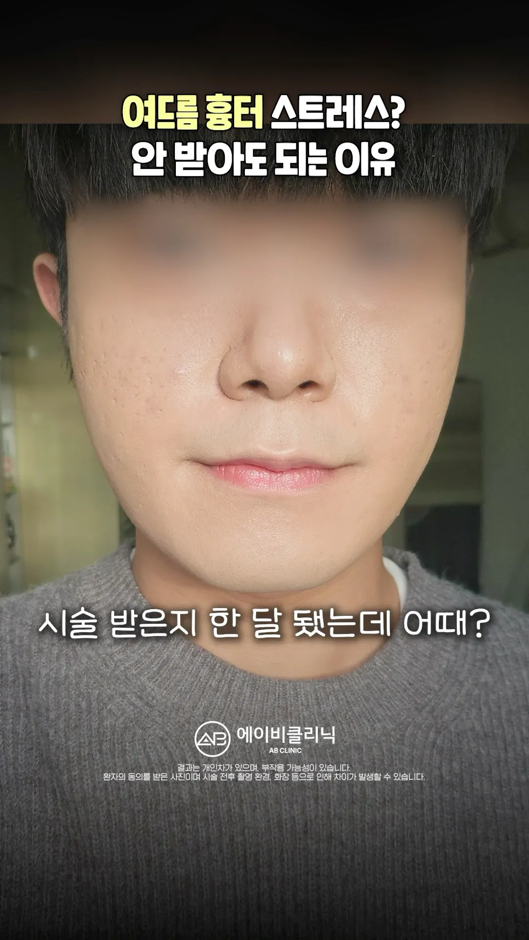 두껍게 가렸던 여드름 흉터, 이것만 받아보세요❗