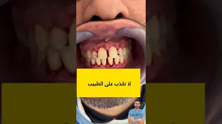 تنظيف الاسنان وإزالة الجير إزالة جير الأسنان دكتور عبدالله سلطان الهنداوي طبيب اسنان Dentist 소아치 