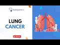 Lung cancer How can you sign up for a consultation https ourexpertdoc com