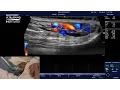 Hot Tips - Testicular Ultrasound for Varicocele