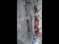 Download Lagu MICRO PREEMIE NOVA BORN AT 29 WEEKS AT 2.9 LBS