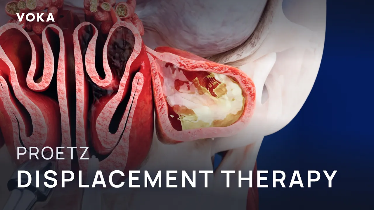 VOKA Proetz displacement therapy animation