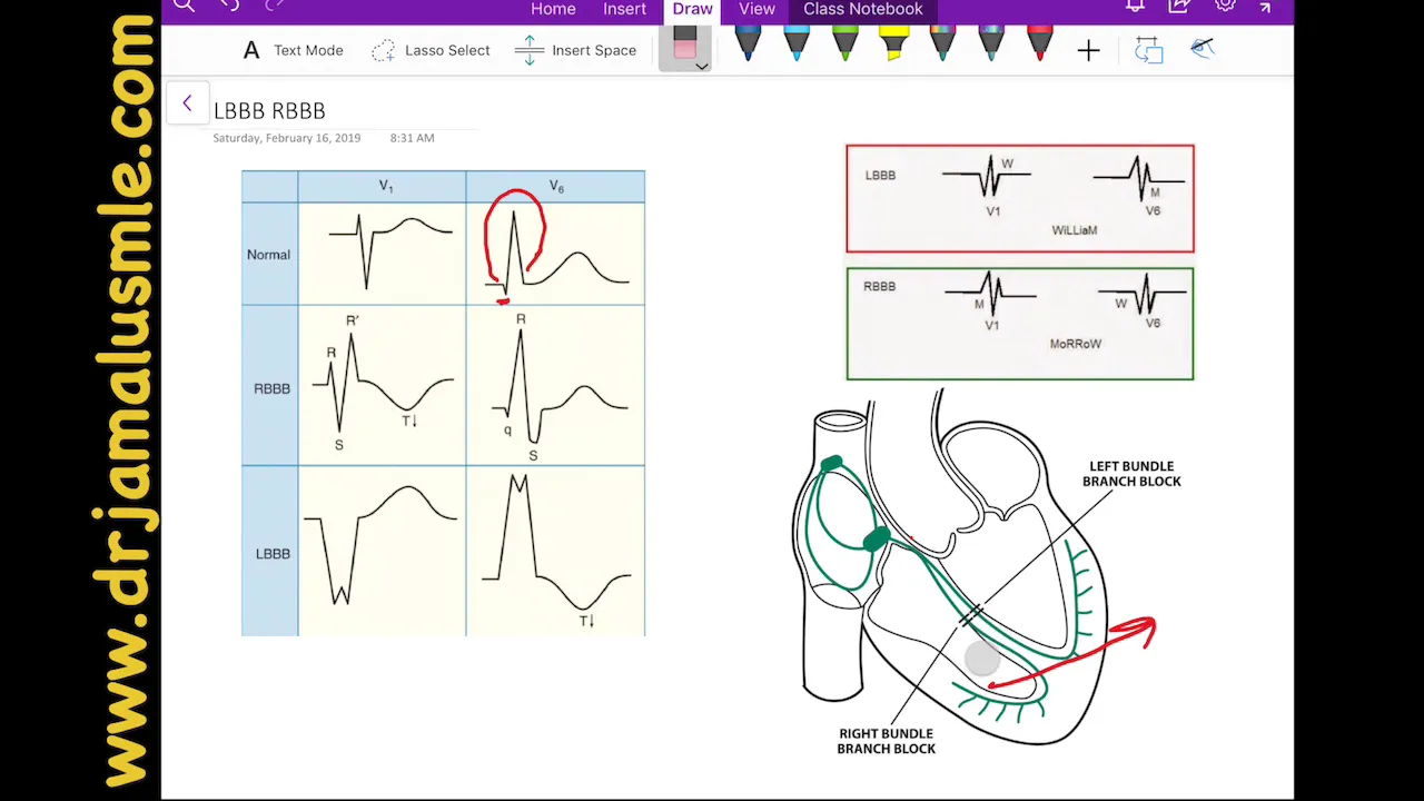 LBBB and RBBB (left VS right bundle branch block)- Dr Jamal USMLE - Cardiology ECG lecture