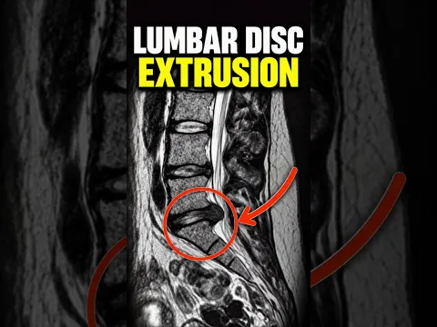 LUMBAR DISC EXTRUSION: CAN IT SHRINK NATURALLY?