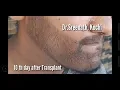 Download Lagu Beard Transplant results after 10 days | Tamil Movie Celebrity | Dr.Sreenath | Beard Transplant