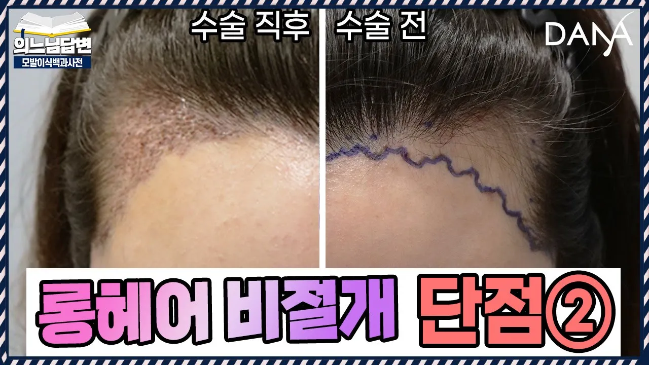 의느님답변📂롱헤어 비절개는 대체제가 아닌 보완재ㅣ롱헤어 비절개 장점과 단점②ㅣ다나성형외과(DANA)ㅣ모발이식ㅣ헤어라인교정ㅣ두피문신ㅣ탈모치료