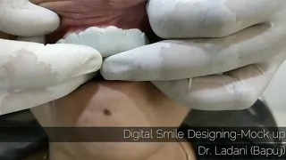 Smile Designing Dr Ladani 