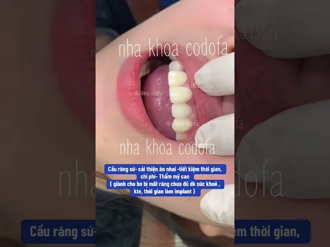 cầu răng sứ #nhakhoacodofa #dentist #răngsứthẩmmỹ #veneers