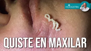 Quiste sebáceo en maxilar