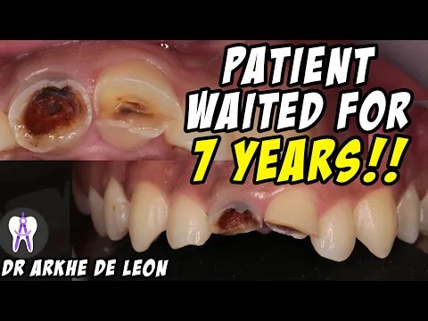 Download MP3 Amazing Case of Fractured Teeth Restored with Zirconia Crown #4k #C29