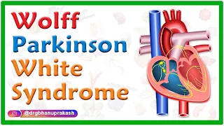 Wolff Parkinson White Syndrome WPW Causes Mechanism ECG Findings And Diagnosis Treatment 