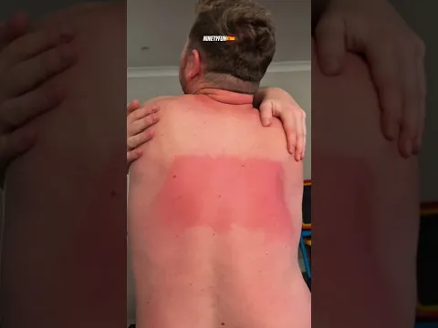¡Se olvidó del protector solar y mira lo que pasó! ☀️😱