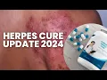 Herpes Cure Update 2024