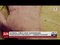 Eczema, hindi lang karaniwang pangangati ng balat – dermatologist