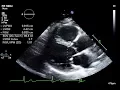 Download Lagu Routine Echocardiogram Protocol With Standard 2D Echo Images and Color Doppler