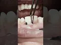 Download Lagu Removing retraction cord after RCT and composite restoration for anterior teeth #satisfying