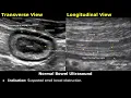 Download Lagu Small Bowel Ultrasound Reporting | How To Write USG Report | Bowel Obstruction, Crohn's Disease