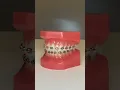 Braces Color Combination Red and Black Check out this braces color combo of red and black