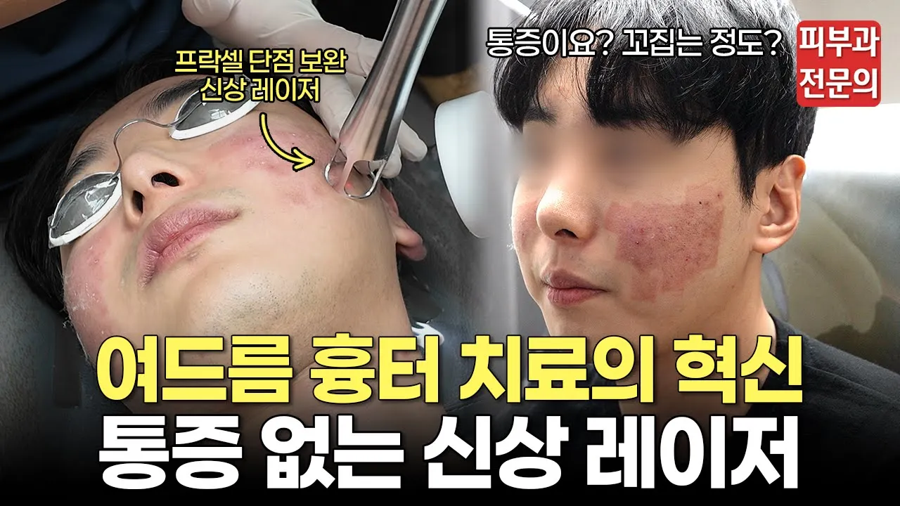 신세대 흉터 치료 레이저 '울트라 클리어' 어떻게 시술할까?ㅣ울트라클리어, 울트라클리어 레이저, 여드름 흉터, 여드름 흉터 치료, 피부 탄력, 잔주름, 프락셀, 울리고, 큐어트라