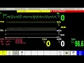 Download Lagu Anesthesia Scenario