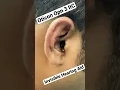 Download Lagu Invisible Hearing Aid || Oticon Opn 3 Power IIC || Smallest Hearing Aid || 48 Channels || HearExpert
