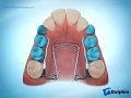 Quad Helix Appliance