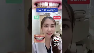  วิธีการรักษาช่องว่างระหว่างฟันที่มีอยู่ใน 3 วิธีนี้ มีข้อดีและข้อเสียอย่างไรบ้าง 