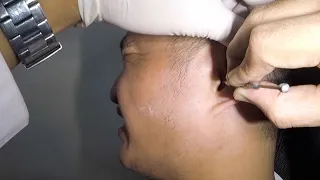 Trying to Remove Man's Hard Earwax