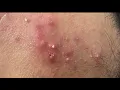 Inflammatory Acne #HoangMySpa162
