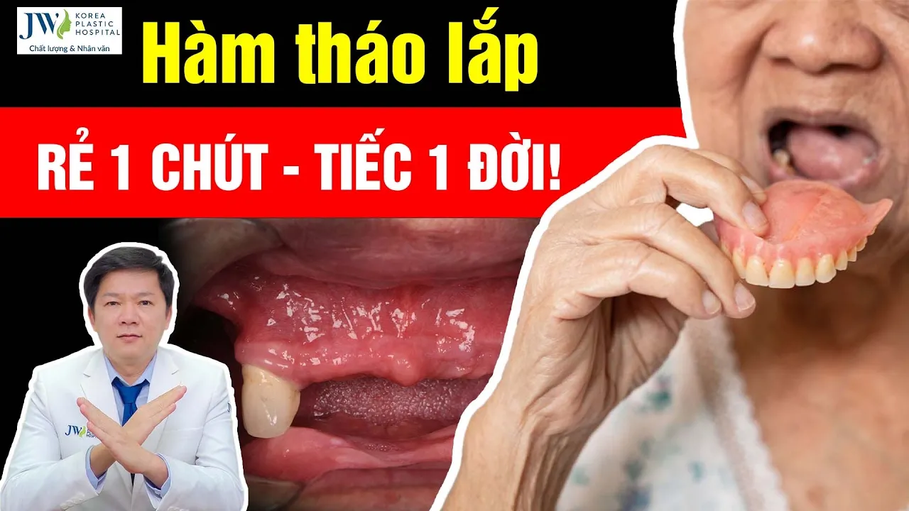 Outline Video Bác sĩ Tú Dung KHUYẾN CÁO người mất răng nên chọn HÀM THÁO LẮP hay CẤY GHÉP IMPLANT ALL ON 4