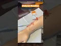 Mastering Dialysis - Learn How To Insert Needles For AV Fistula